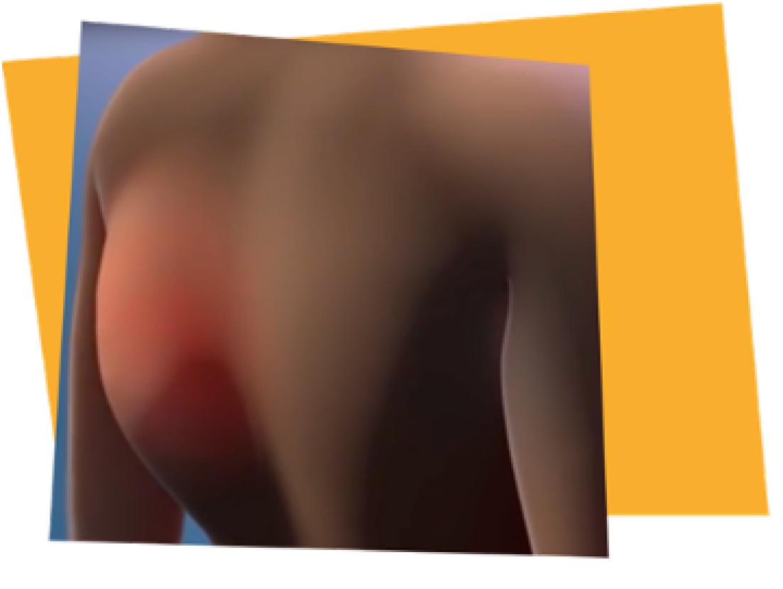 what-is-a-fop-flare-up