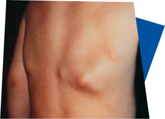 swellings-lumps-bumps